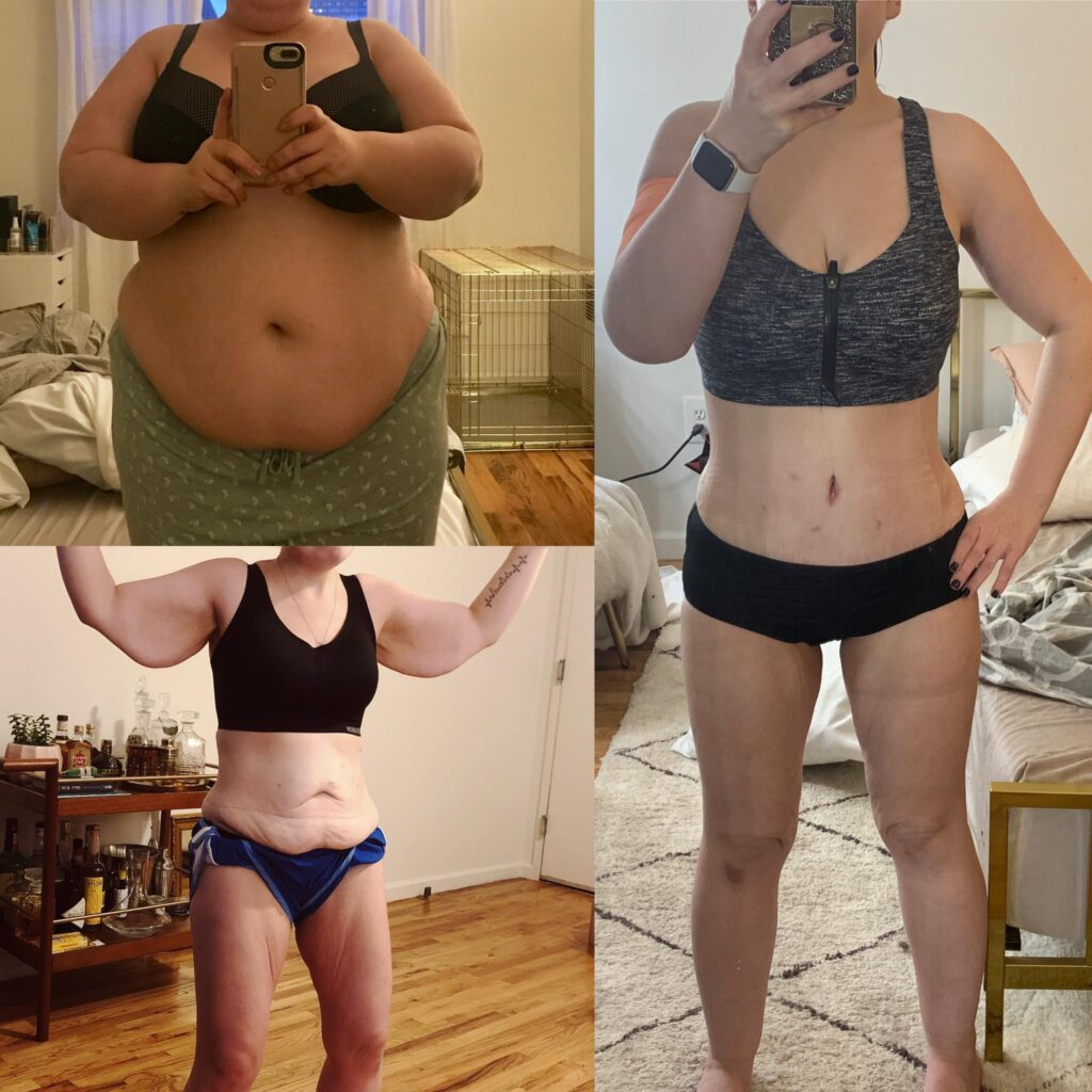 Semaglutide Weight Loss Before And After In Bradenton Weight Loss 